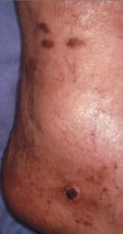 Skin lesion