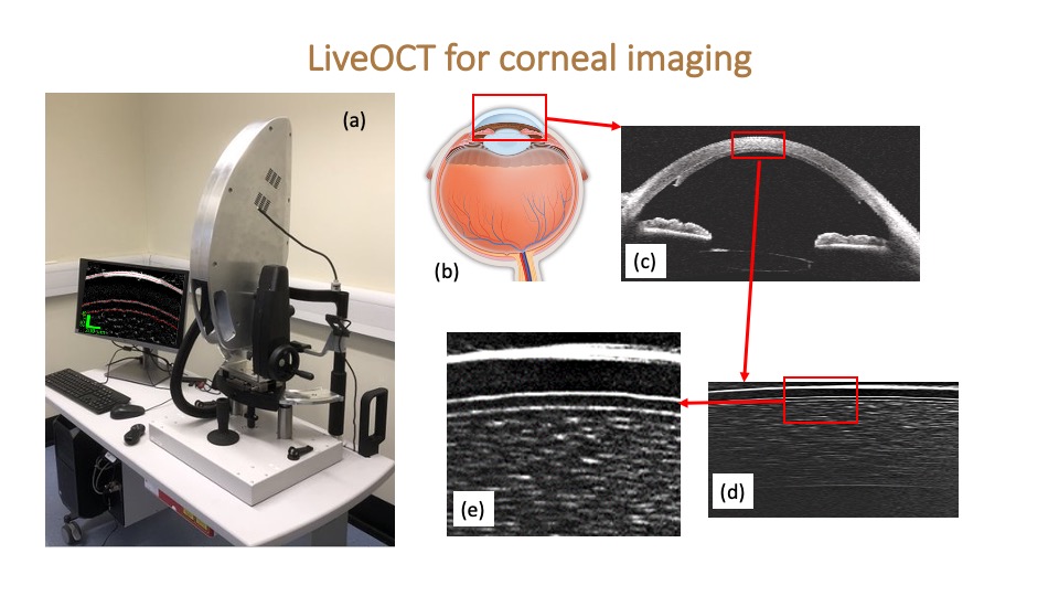 (a) A photo of the LiveOCT device, (b) schematic diagram of human eye, (c) OCT image showing an overview of cornea. OCT image obtained using our ultrahigh resolution LiveOCT (d), and its enlarged view (e).