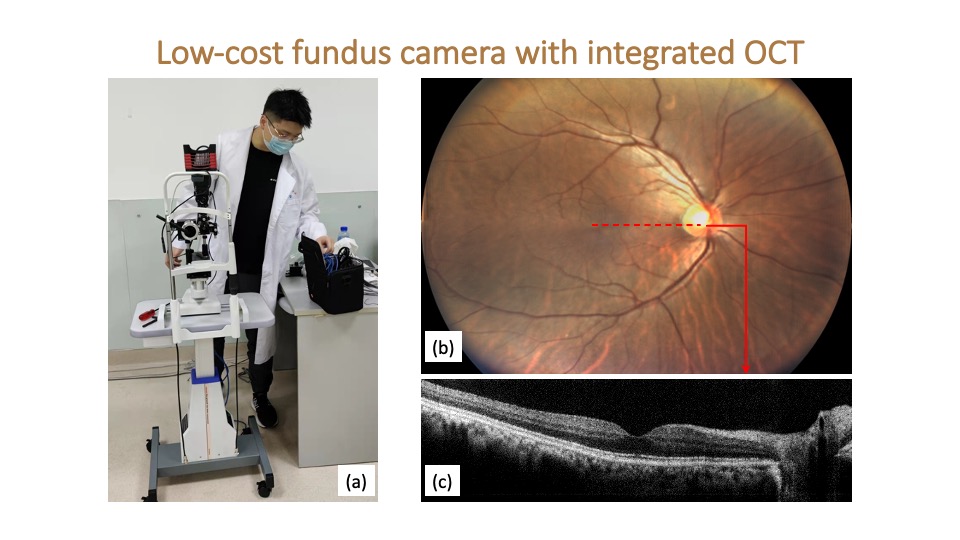 (a) Photograph of the new low-cost true-colour fundus camera with an integrated OCT, designed specifically for the DR screening needs of China. The high-quality colour image (a) and OCT image (b) of the retina obtained using our new camera without pupil dilation.