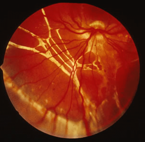 Subretinal PVR membrane (white strands) seen beneath the neural retina