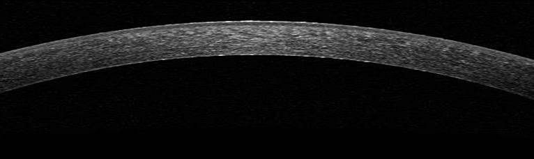Optical Coherence Tomography (OCT) image of the human cornea (Vito Romano) 